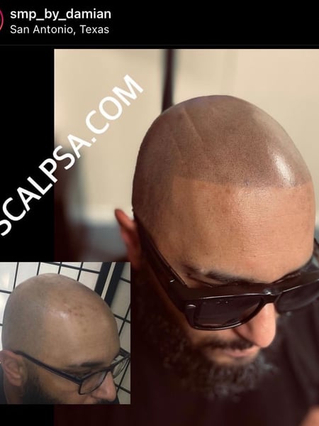 Image of  Cosmetic, Scalp Micropigmentation, Cosmetic Tattoos