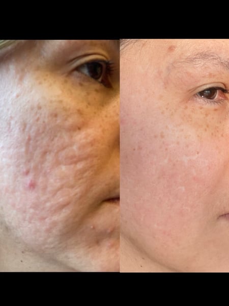 Image of  Forehead, Chin, Filler, Lips, Cheeks, Smile Lines, Cosmetic, Skin Treatments, Cosmetic Tattoos, Neurotoxin, Facial, Chemical Peel, Dermaplaning, Laser Skin Resurfacing, IPL Photofacial, Upper Face, Eyes, Lower Face, Skin Pigmentation, Body Sculpting, Radio Frequency, Skin Treatments