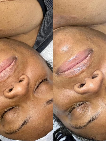 Image of  Microdermabrasion, Skin Treatments, Facial
