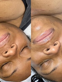 View Microdermabrasion, Skin Treatments, Facial - Takiyah Rockmore, Dallas, TX