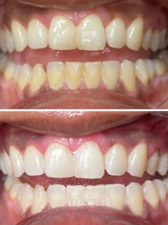 View Teeth Whitening, Cosmetic - Sharelle Castro, Mililani, HI