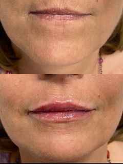 View Lips, Filler, Cosmetic - Katelyn Burke, Windham, NH