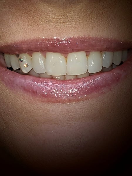 Image of  Filler, Lips, Cosmetic, Cosmetic Tattoos, Teeth Whitening, Lip Blush , Dentistry, Teeth Bleaching