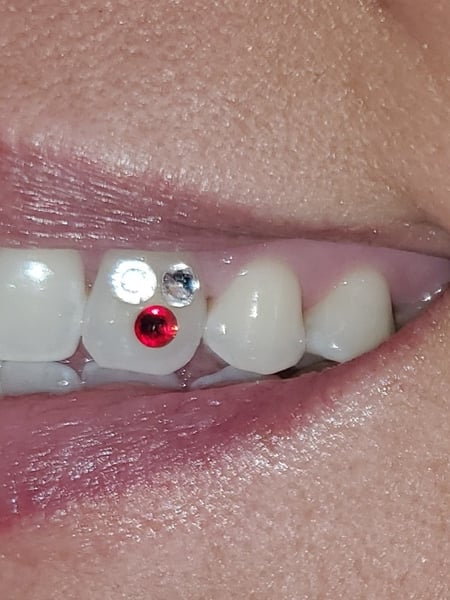 Image of  Filler, Lips, Cosmetic, Teeth Whitening, Dentistry, Teeth Bleaching
