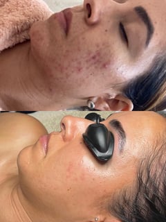 View Facial, Skin, LED Acne Therapy, HydraFacial - Hannah Lebron, La Mesa, CA