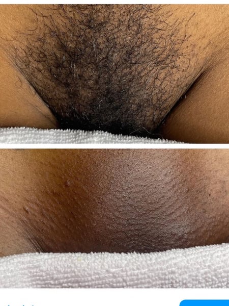 Image of  Waxing, Hair Removal