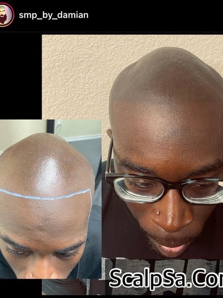 Image of  Cosmetic, Scalp Micropigmentation, Cosmetic Tattoos