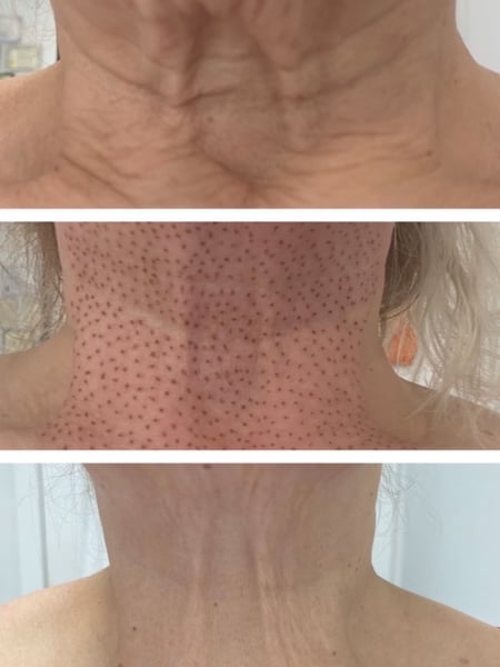 Image of  Cosmetic, Neck Tightening, Minimally Invasive, Skin Treatments