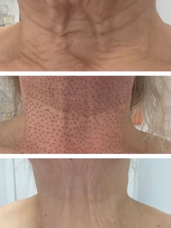 View Neck Tightening, Skin Treatments, Cosmetic, Minimally Invasive - Bianka Mati, Miami, FL