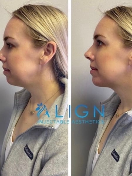 Image of  Chin, Filler, Cosmetic