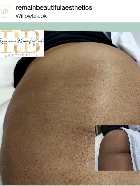 Image of  Back, Waxing, Hair Removal
