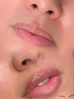 View Lips, Filler, Cosmetic - Marybi Cortes, Las Vegas, NV