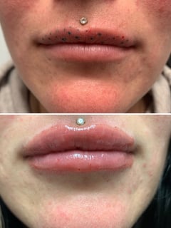 View Cosmetic, Filler, Lips - Nathalie Pebbles Tapia, 