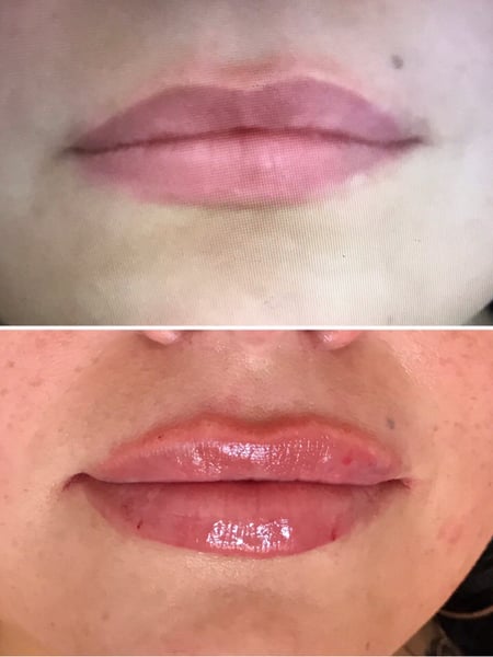 Image of  Cosmetic, Lips, Filler
