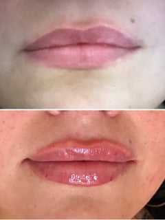 View Cosmetic, Lips, Filler - Suzanne Sexton, Aurora, CO