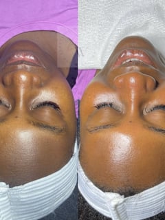 View Cosmetic, Skin Treatments - Ranneisha Johnson, Cedar Hill, TX