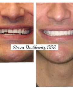 View Porcelain Veneers, Dentistry, Dentistry Services - Dr. Steven Davidowitz, New York, NY