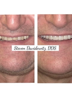 View Porcelain Veneers, Dentistry Services, Dentistry - Dr. Steven Davidowitz, New York, NY