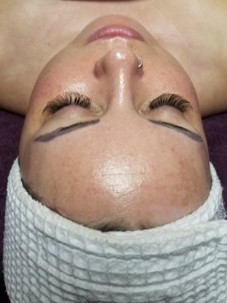 Image of  Facial, Skin Treatments, Chemical Peel