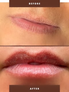 View Cosmetic, Filler, Lips - Monica , Algona, WA