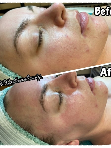 Image of  Facial, Skin Treatments, Microdermabrasion