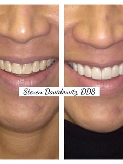 View Dentistry Services, Porcelain Veneers, Dentistry - Dr. Steven Davidowitz, New York, NY