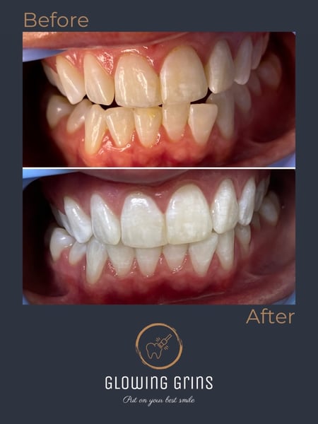 Image of  Teeth Whitening, Dentistry, Dentistry Services