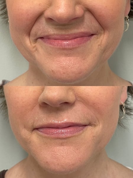 Image of  Filler, Smile Lines, Cosmetic