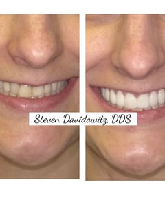 View Porcelain Veneers, Dentistry Services, Dentistry - Dr. Steven Davidowitz, New York, NY