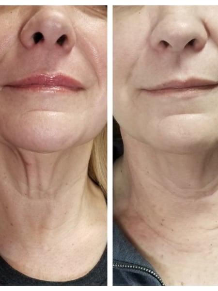 Image of  Cosmetic, Minimally Invasive, Neck Tightening, Skin Treatments, Facial