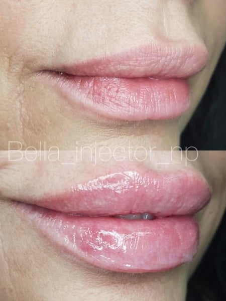 Image of  Cosmetic, Lips, Filler