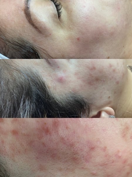 Image of  Cosmetic, Skin Treatments, Chemical Peel, Facial