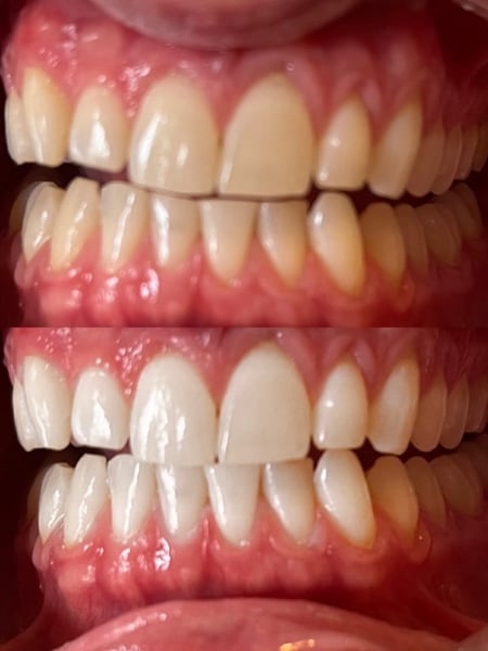 Image of  Teeth Whitening, Dentistry, Teeth Bleaching, Dentistry Services