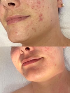 View Cosmetic, Facial, Skin Treatments - Jordan Cox, Gilbert, AZ