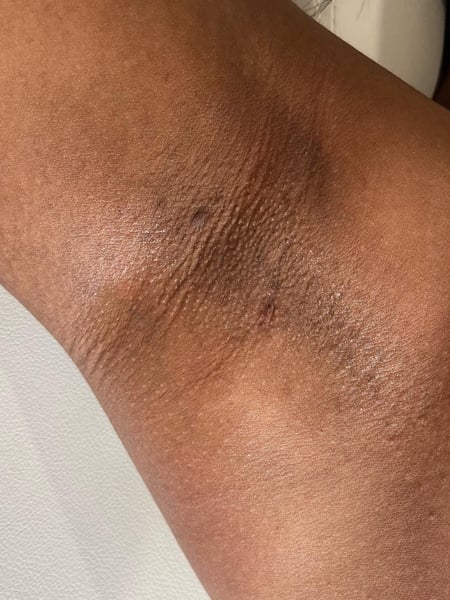 Image of  Cosmetic, Underarms , Waxing