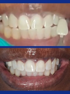 View Dentistry, Cosmetic, Teeth Whitening, Teeth Bleaching - Mila , San Jose, CA