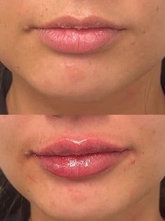 View Filler, Lips, Cosmetic - Katelyn Burke, Windham, NH