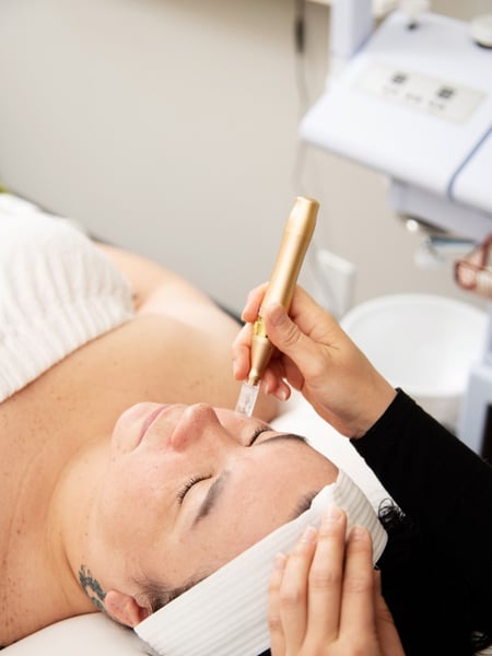 Image of  Skin Treatments, Facial, Microneedling, Skin Treatments