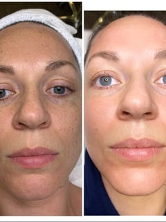 View Microneedling, Microdermabrasion, Facial, Chemical Peel, Skin Treatments, Skin Treatments, HydraFacial, Dermaplaning, LED Acne Therapy - Alder Orme, Meridian, ID