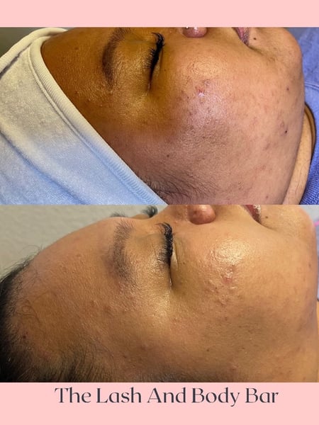 Image of  Cosmetic, Microdermabrasion, Skin Treatments