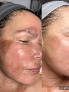View Minimally Invasive, Microdermabrasion, Chemical Peel, Facial, Skin, Cosmetic - Kira Nalani, Chatsworth, CA