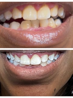View Teeth Whitening, Cosmetic - Jazmin Warren, Atlanta, GA