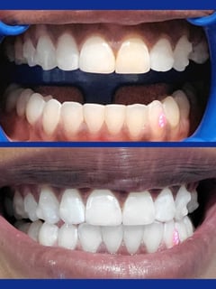 View Cosmetic, Dentistry, Teeth Bleaching, Teeth Whitening - Mila , San Jose, CA