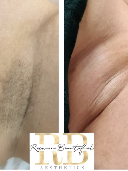 Image of  Underarms , Waxing, Hair Removal