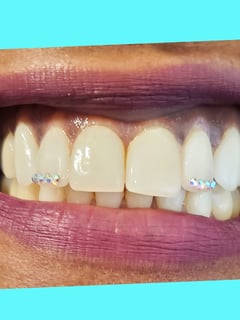 View Filler, Lips, Cosmetic, Cosmetic Tattoos, Teeth Whitening, Lip Blush , Dentistry, Teeth Bleaching - Mila , San Jose, CA