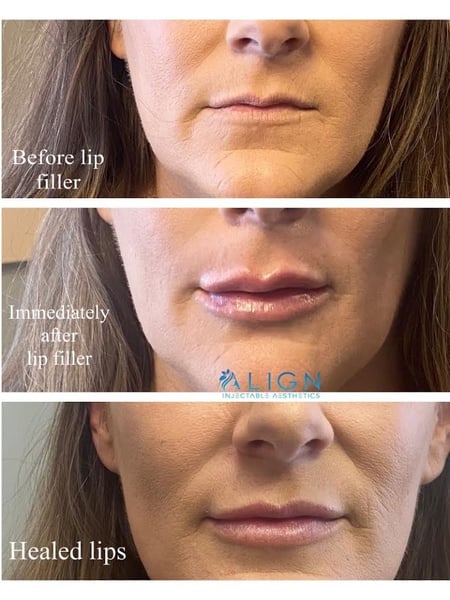 Image of  Filler, Lips, Cosmetic