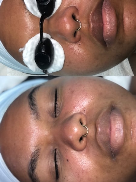 Image of  Facial, Skin Treatments, Microdermabrasion, Waxing