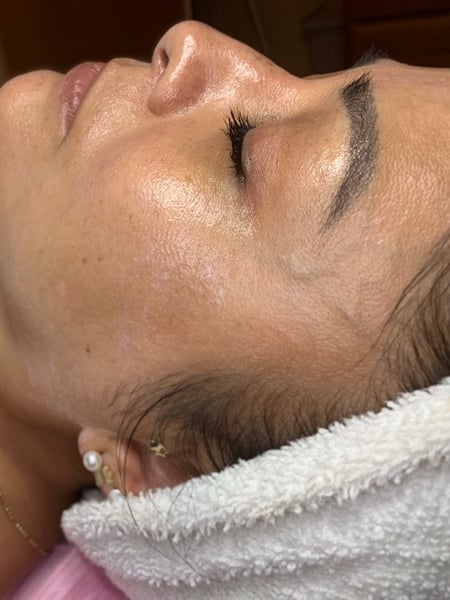Image of  Cosmetic, Skin Treatments, Facial, Chemical Peel
