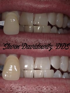 View Dentistry Services, Dentistry, Teeth Whitening - Dr. Steven Davidowitz, New York, NY