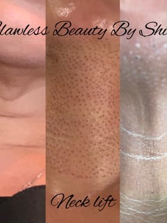 View Cosmetic, Mini Facelift, Minimally Invasive, Neck Tightening, Skin Treatments - Shilo Hope Stanley, La Mesa, CA